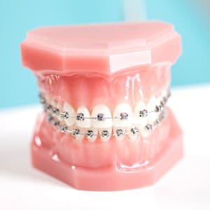Poidmore Orthodontics - metal braces
