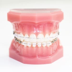 Poidmore Orthodontics - clear braces