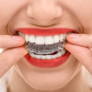 Poidmore Orthodontics - Invisalign retainer