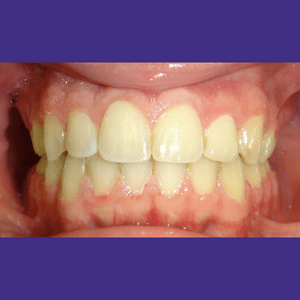 Poidmore Orthodontics - Zaid-after